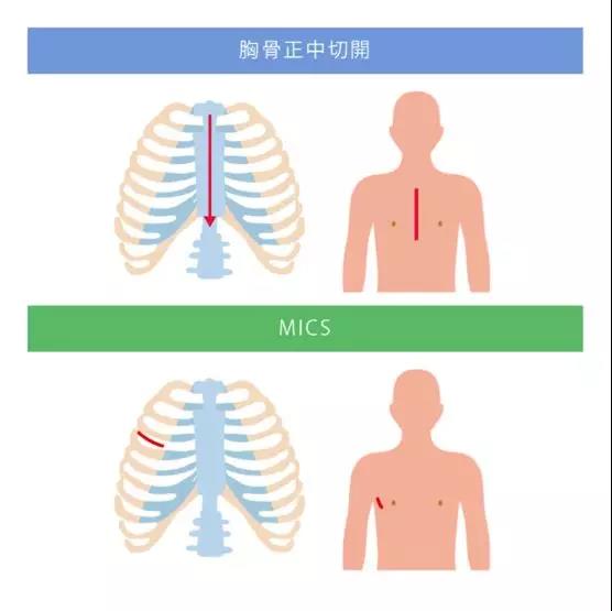 MICS(微創心臟手術)